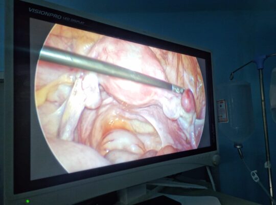 Laparoscopic Procedure