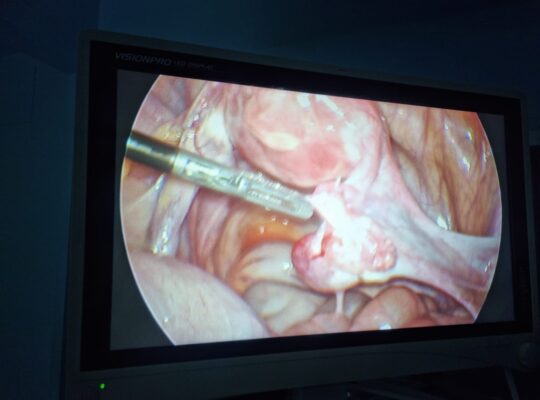 Laparoscopic Procedure